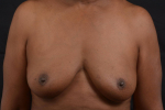 Immediate Breast Reconstruction -  Skin Sparring - Case #47 Before