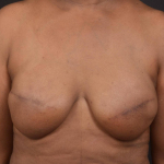 Immediate Breast Reconstruction -  Skin Sparring - Case #47 After