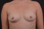 Breast Augmentation Silicone Gel - Case #82 Before
