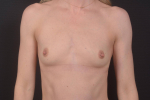 Breast Augmentation Silicone Gel - Case #83 Before