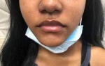 Patient 1 - Restylane Kysse Before