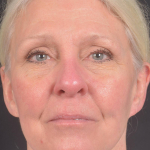 Facelift Revision- Case #25 Before