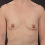 Breast Augmentation Silicone Gel - Case #85 Before