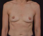 Breast Augmentation with Nipple Reduction - Case #62 Before