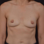 Breast Augmentation with Nipple Reduction - Case #62 Before