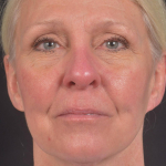 Face & Neck Lift - Case #27 Before