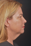 Face & Neck Lift - Case #29 Before