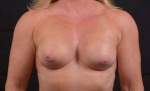 Breast Revision - Case #59 Before