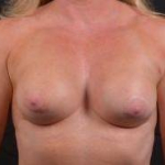 Breast Revision - Case #59 Before