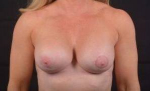 Breast Revision - Case #59 After