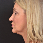 Face & Neck Lift - Case #30 Before