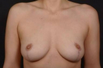 Bilateral Mastopexy After