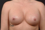 Breast Augmentation Silicone Gel- Case BASG-98 After
