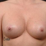 Breast Augmentation Silicone Gel- Case BASG-98 After