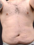Male Abdominoplasty with Lipo 360- Case AP 83 Before