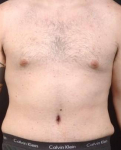 Male Abdominoplasty with Lipo 360- Case AP 83 After