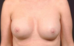 Bilateral Mastopexy with Breast Implant Removal and Fat Grafting to Breasts- Case M45 Before