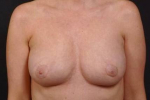 Bilateral Mastopexy with Breast Implant Removal and Fat Grafting to Breasts- Case M45 After