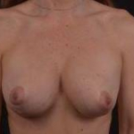 Breast Revision - Case #56 Before