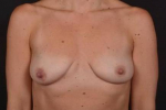 Breast Augmentation Silicone and Mastopexy Before