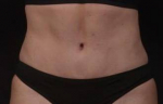 Abdominoplasty with Lipo 360 After