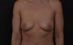 Breast augmentation and Mastopexy- Case 77 Before