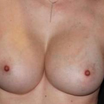 Breast Augmentation Silicone- Case 101 After