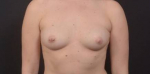 Breast Augmentation Silicone- Case 102 Before