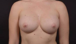 Breast Augmentation Silicone- Case 102 After