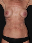 Breast Rev: Mastopexy Breast Aug/ Abdominoplasty- Case 37 Before