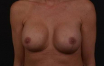 Breast Revision: Mastopexy with Pocket Revision and Galaflex- Case 73 After