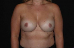 Breast Augmentation - Case #104 After