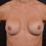 Breast Revision - Case #51 Before