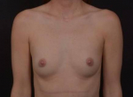 Breast Augmentation - Case #105 Before