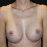 Breast Augmentation - Case #105 After