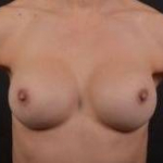 Breast Revision - Case #51 After