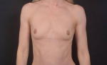 Breast Augmentation - Case #106 Before