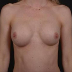 Breast Augmentation - Case #106 After