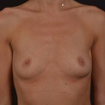 Breast Augmentation - Case #107 Before