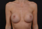 Breast Augmentation - Case #107 After