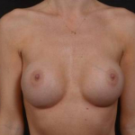 Breast Augmentation - Case #107 After