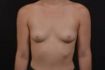 Breast Augmentation - Case #108 Before