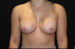Breast Augmentation - Case #108 After