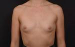 Breast Augmentation - Case #109 Before