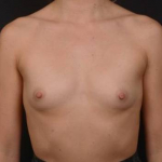 Breast Augmentation - Case #109 Before