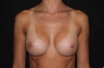 Breast Augmentation - Case #109 After