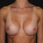 Breast Augmentation - Case #109 After
