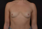 Breast Augmentation - Case #110 Before