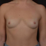Breast Augmentation - Case #110 Before