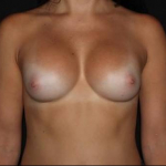 Breast Augmentation - Case #110 After
